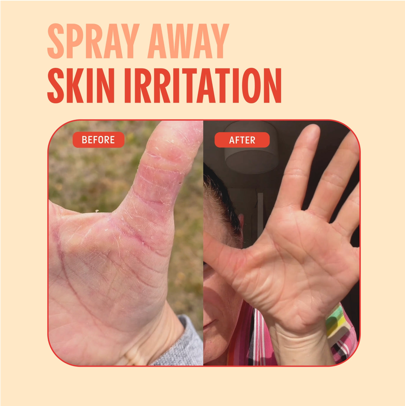 Hypochlorous Acid Facial Spray for Acne, Eczema, Rosacea